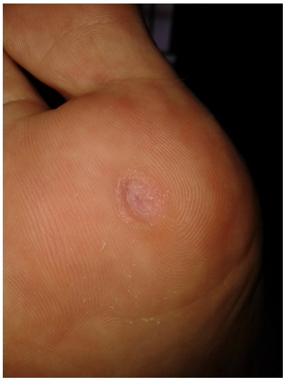 RAD 100-3 -2d Tratamiento de verruga plantar con bleomicina: presentación de un caso | Plantar wart treatment with bleomycin: presentation of a case