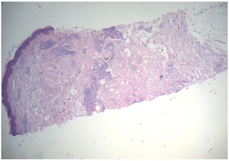 Revista Argentina de Dermatología - 100 - 4 - Granuloma anular atípico 3