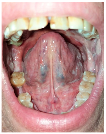 Revista Argentina de Dermatología - 100 - 4 - Leucoplasia verrucosa 5