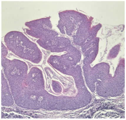 Revista Argentina de Dermatología - 100 - 4 - Leucoplasia verrucosa 8