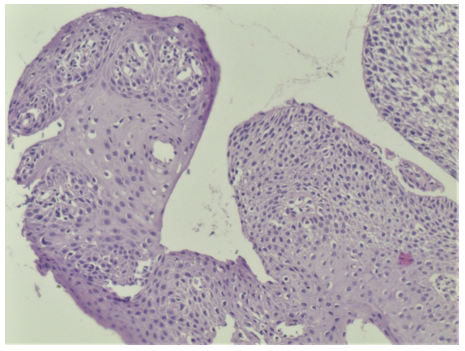 Revista Argentina de Dermatología - 100 - 4 - Leucoplasia verrucosa 9