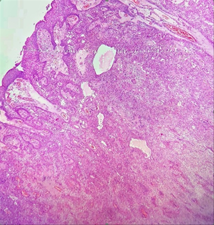 Figura 3: Se evidencia tumor que desprende de la epidermis, organizado en lóbulos con células que mostraban citoplasma claro y formas en algunas áreas de estructuras ductales.