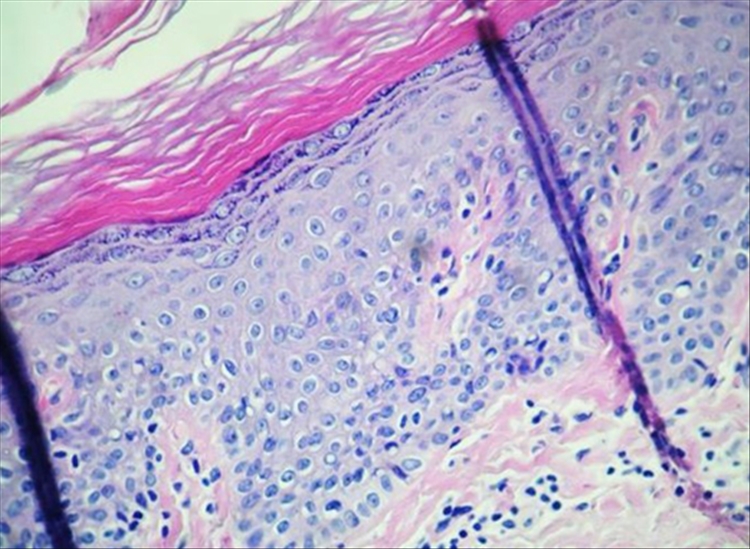Figura 3. Imagen de corte histológico en el que se observa epidermis con ortoqueratosis, granulosa conservada, leve degeneración vacuolar de la basal, presentan a nivel dermoepidérmico una leve dermatitis de interfase, con un infiltrado linfocitario en dermis papilar (HE 100x).