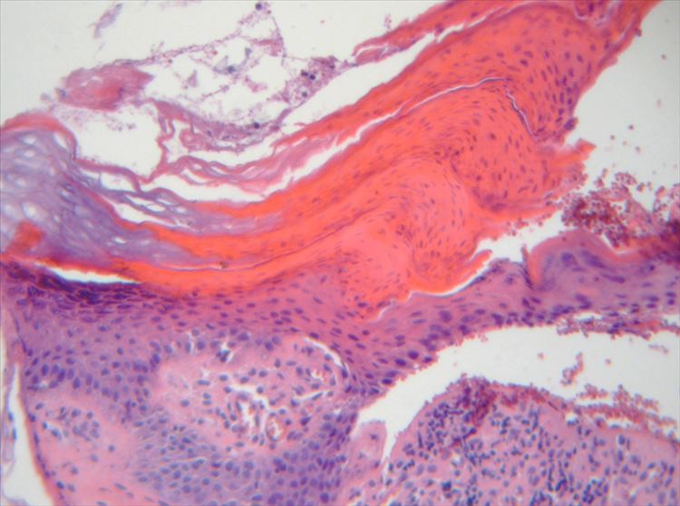 Figura 4: Tinción H-E 400x: lamela cornoide, bajo la cual se observa disminución de capa granulosa. Presencia de un infiltrado inflamatorio linfohistiocitario leve.