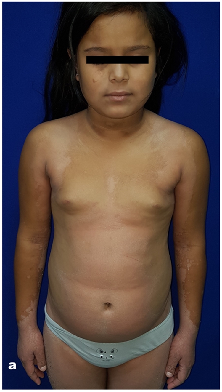 Figura 1 a: Pitiriasis rubra pilaris, tipo IV o juvenil circunscrito (caso 1). Lesiones bilaterales y simétricas constituidas por descamación y pápulas que persisten en piernas
