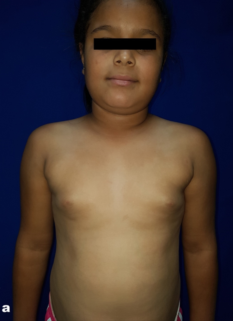 Figura 3 a: Pitiriasis rubra pilaris, tipo IV o juvenil circunscrito (caso 1). Notable mejoría de las lesiones a las seis semanas, con el uso de emolientes.