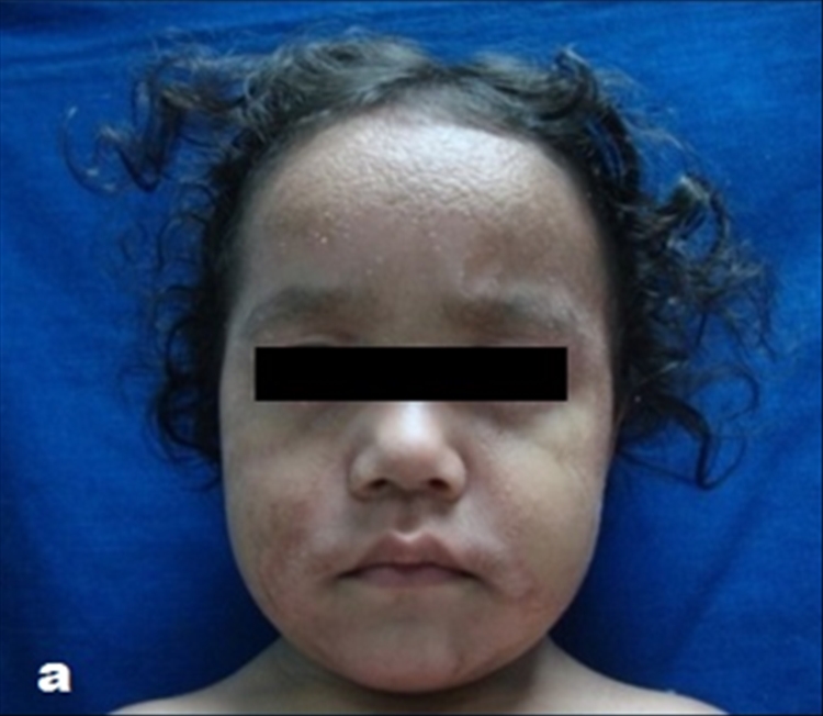 Figura 4 a: Pitiriasis rubra pilaris, tipo III o juvenil clásico. Pápulas foliculares y descamación fina en la cara.