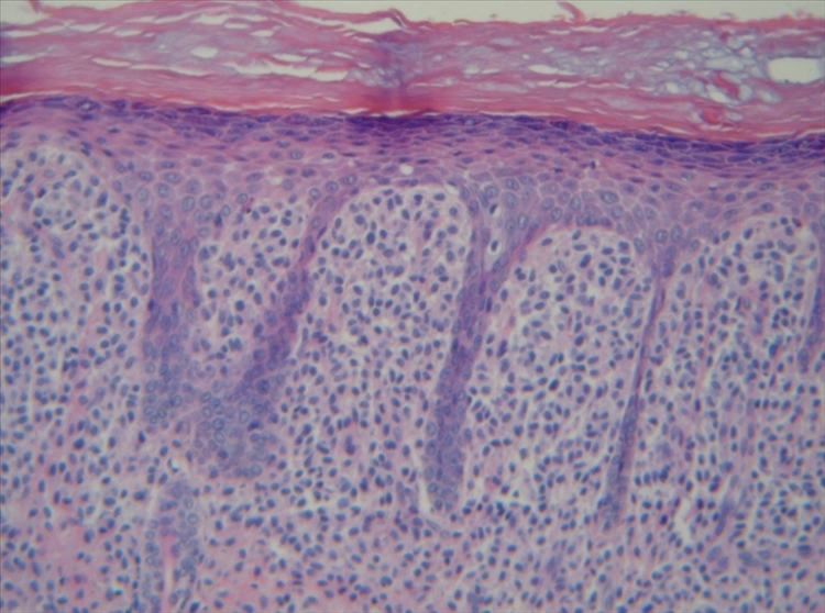 Figura 2. H&E 10X Se observa infiltrado denso de mastocitos en dermis papilar.