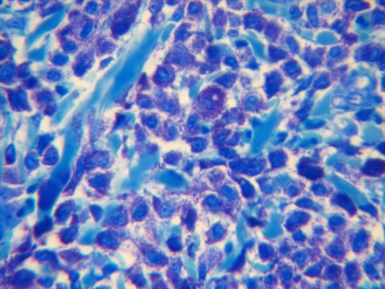 Figura 3. : L a coloración de azul de Toluidina destaca los gránulos metacromáticos intracitoplasmáticos de los mastocitos.