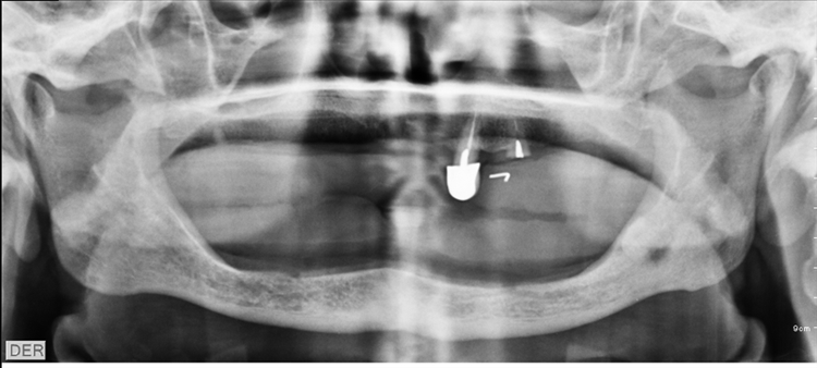 Fig.2: Ortopantomografía: en la región mandibular izquierdo, imagen radiopaca secundaria a la presencia de resto radicular del elemento 38, rodeado por imagen osteolítica de bordes regulares de 0.6 mm de diámetro e imagen radiolúcida compatible con fistula.