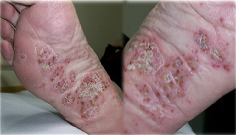 Dermatosis Pustulosa Subcórnea 03