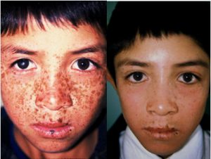 Xeroderma pigmentoso. Breve revisión de lo molecular a lo clínico – Revista Argentina de Dermatología