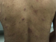 Síndrome hipereosinofílico asociado a linfoma T periférico Figura 2: Se asocian placas eritematovioláceas con costras hemáticas en el dorso